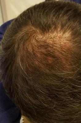 after-hair-transplant (13)