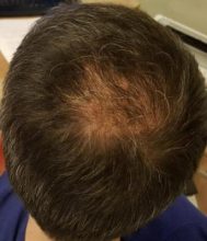 after-hair-transplant (14)