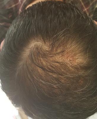 after-hair-transplant (18)