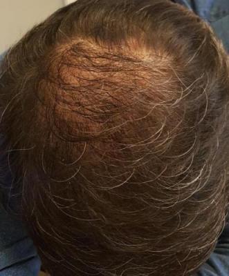after-hair-transplant (19)