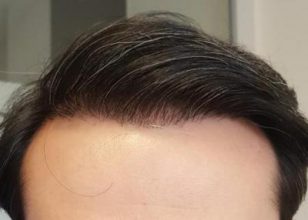 after-hair-transplant (2)