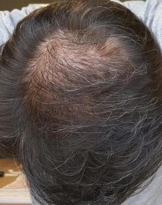after-hair-transplant (21)
