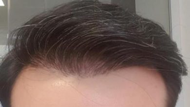 after-hair-transplant (23)