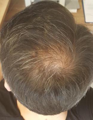 after-hair-transplant (24)