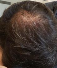 after-hair-transplant (26)