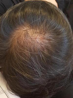 after-hair-transplant (3)