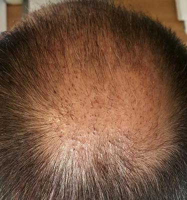 after-hair-transplant (5)