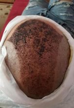 after-hair-transplant (6)