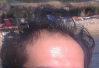 after-hair-transplant (7)