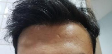beard-hair-transplant (11)