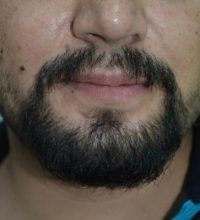 beard-hair-transplant (13)