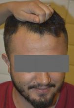beard-transplant (7)