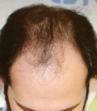 before-hair-transplant (4)