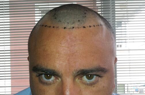 Ph D Muttalip Keser Fue 1900 Grafts Ankara Turkey Hair Transplant In Turkey