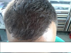 hair-clinic-ankara-turkey (14)