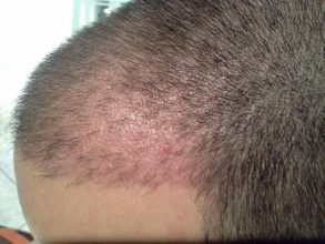 hair-clinic-ankara-turkey (9)