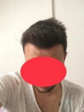 hair-restoration-cost (1)