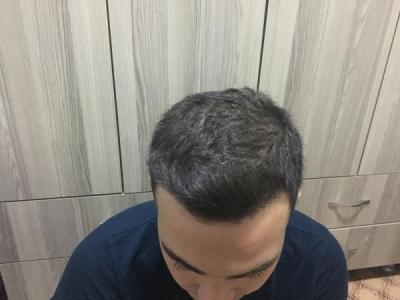 hair-restoration-cost (10)