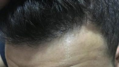 hair-restoration-cost (12)