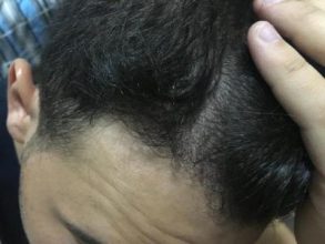hair-restoration-cost (14)