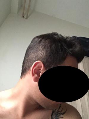 hair-restoration-cost (20)
