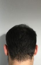 hair-restoration-istanbul (11)
