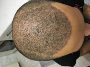 hair-restoration-istanbul (14)