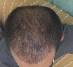 hair-restoration-istanbul (15)