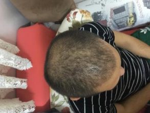 hair-restoration-istanbul (17)