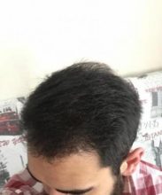 hair-restoration-istanbul (18)