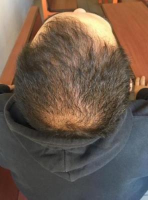 hair-restoration-istanbul (20)