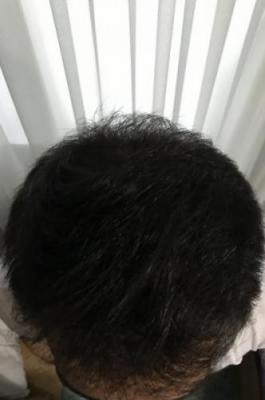 hair-restoration-istanbul (21)