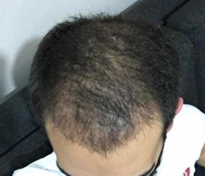 hair-restoration-istanbul (8)