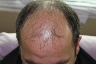 hair-transplant-antalya-turkey (16)