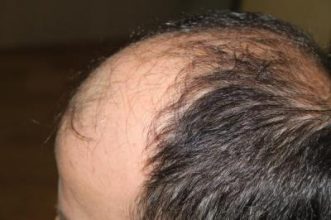 hair-transplant-antalya-turkey (17)