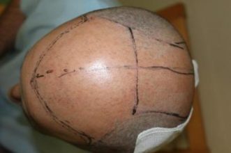 hair-transplant-antalya-turkey (20)