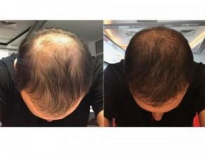hair-transplant-cost-turkey (12)