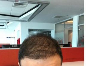 hair-transplant-cost-turkey (17)