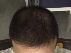 hair-transplant-cost-turkey (18)
