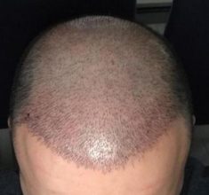 hair-transplant-cost-turkey (2)