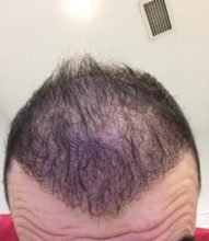 hair-transplant-cost-turkey (22)
