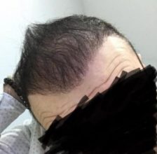 hair-transplant-cost-turkey (25)