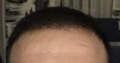 hair-transplant-cost-turkey (32)