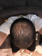 hair-transplant-cost-turkey (37)