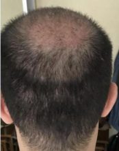 hair-transplant-cost-turkey (4)
