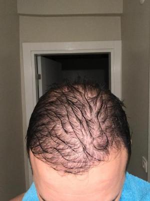 hair-transplant-cost-turkey (43)