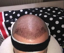 hair-transplant-cost-turkey (44)