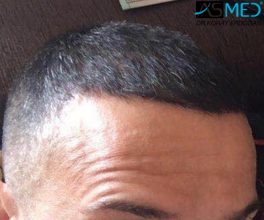 hair-transplant-erdogan-turkey (1)