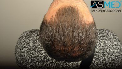 hair-transplant-erdogan-turkey (9)