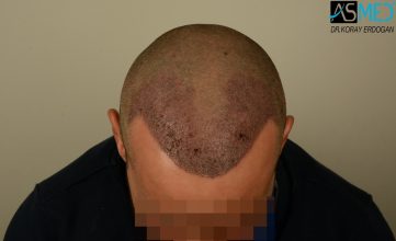 hair-transplant-istanbul (11)